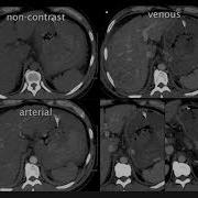 Ct Protocol