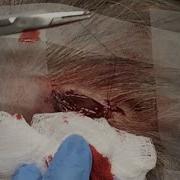 Ninis Mystery Scalp Lesion Excision Part 2