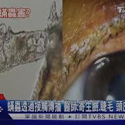 小心 蟎蟲寄生在身體 這部位 引起發炎物質 醫師 出現永久性傷害