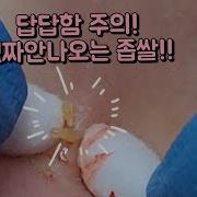 좁쌀여드름 짜기