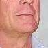 What Is Aphasia Bruce Willis Diagnosed With Condition That Affects Communication