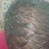 Shocking Results Of Avimee Herbal Keshpallav Hair Oil Hairtone PV 1 Scalp Spray Haircare Avimee