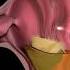 ASMR Acid Reflux