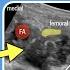 PENG Block Pericapsular Nerve Group Block