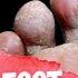 BEST Athlete S Foot Fungus Treatments HOME Remedies 3 BIG SECRETS