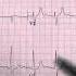 59 Year Old Male High Blood Pressure Ekg Ecg Electrocardiogram Uri Ben Zur Md Facc