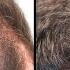 Oral Minoxidil A Better Hair Loss Treatment