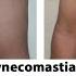 Gynecomastia Surgery Before After Results After 10 Days Gynecomastia Surgery Before After Results