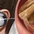 ASMR Ear Cleaning And Earwax Removal