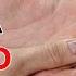 How To Treat A Jammed Finger Health Sutra