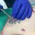 Ever Wonder How Deep A Tattoo Penetrates Your Skin Mommymakeover Liposuction Tummytuck