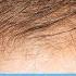 DHEA For Hair Loss Is It Effective Or Not