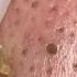 黑頭粉刺 Blackheads Taiwan New Taipei City 大台北清粉刺最乾淨