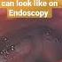 How THROAT CANCER Looks On ENDOSCOPY Smoking Causes CANCER Shorts Viral Shortsvideo Trending