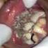 Oral Myiasis