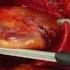 Ependimoblastoma Post Mortem Mutilation Colon Explosion Surgeries For Pleasure