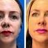 Reno Tahoe Morpheus CO2 Laser Healing From Skin Tightening And Resurfacing Dr Erez Dayan