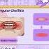 Angular Cheilitis Oral Medicine Medi Study Go