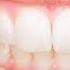 New Study Wants To Explore Link Between Obesity And Gum Disease