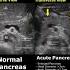 Acute Pancreatitis Ultrasound Pancreas Normal Vs Abnormal USG Shorts Ultrasound Radiology