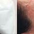 Morpheus 8 Radio Frequency Microneedling Treatment Before After Full Procedure Recovery