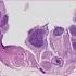 What Is Carcinoma In Situ Pathology Mini Tutorial