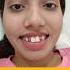 Transform Your Smile With CAD CAM Zirconia Crowns Dr Srishti Bhatia Dentist