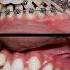 How To Braces Fix Extremely Crooked Teeth Braces Orthodontist Bracesoff