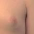 Causes And Treatments For Puffy Nipples In Men Explained By Dr Steven Teitelbaum