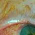 Conjunctival Cautery For Conjunctivochalasis