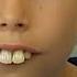 Boy Bullied For Buck Teeth Gets New Smile After Donations Pour In Newshub