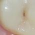 A Black Spot On The Tooth Can Develop Into A Monster