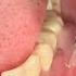 Incision And Drainage Of Tooth Abscess Draining Pus