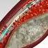 Saving Hearts One Stent At A Time See Angioplasty Stent Placement Stents