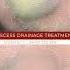 Think Abscess Drainage Treatment Is Too Good To Be True We Have News For You Viral Shorts