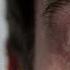 What Causes Bloodshot Eyes Dr Berg