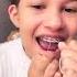 How To Floss Braces With Superfloss