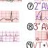 Most Common ECG Patterns You Should Know