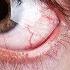 What Causes Visible Red Fine Lines In Eyes Dr Elankumaran P