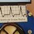 Akselere Ventriküler Kaçış Ritmi Accelerated Ventricular Escape Rhythm