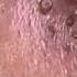 Huge Nose Whitehead Coming Out All Biggest Nose Blackhead Blackhead Blackheads Acne