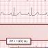 Advanced EKGs PACs And PVCs I E Premature Beats