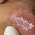 Big Pimples Acne Treament Under The Skin 027