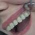 Новые зубы быстро и красиво New Teeth Quickly And Beautifully Implantation