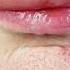 What Is Granulomatous Cheilitis Shorts