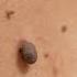 How To Rid Skin Tags FASTER 3 Easy Skin Tag Removal Steps