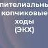 Эпителиальный копчиковый ход сокр ЭКХ или дермоидная киста копчика хирург киста копчик экх