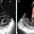 Left Ventricular Non Compaction Cardiomyopathy LVNC