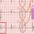 ECG Interpretation Made Easy Learn How To Interpret An ECG In 13 Minutes