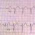 Asthma Tobacco EKG ECG Eletcrocardiogram Dr Uri Ben Zur